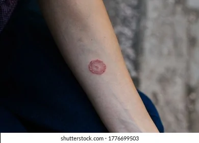 ring-worm-infection-dermatophytosis-on-260nw-1776699503.webp
