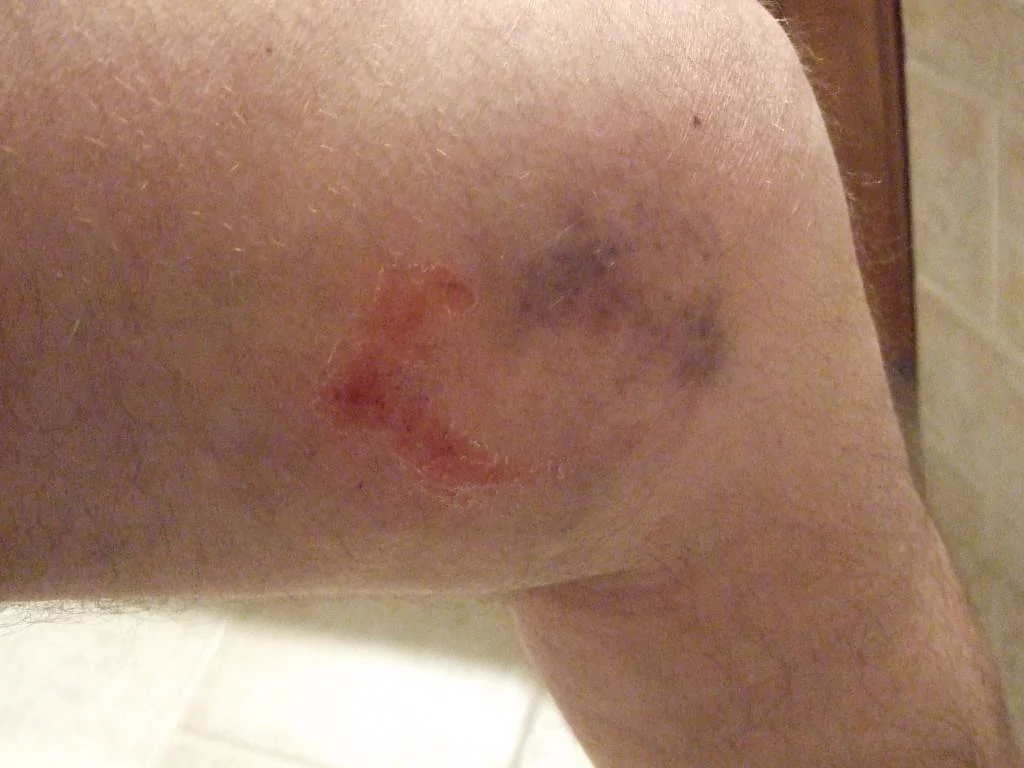 Knee Initial Injury .webp