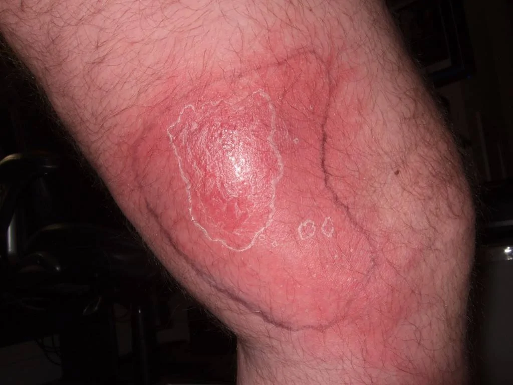 Knee 10 days After Ultrasound MRSA Infection 7days antibiotics Injury .webp