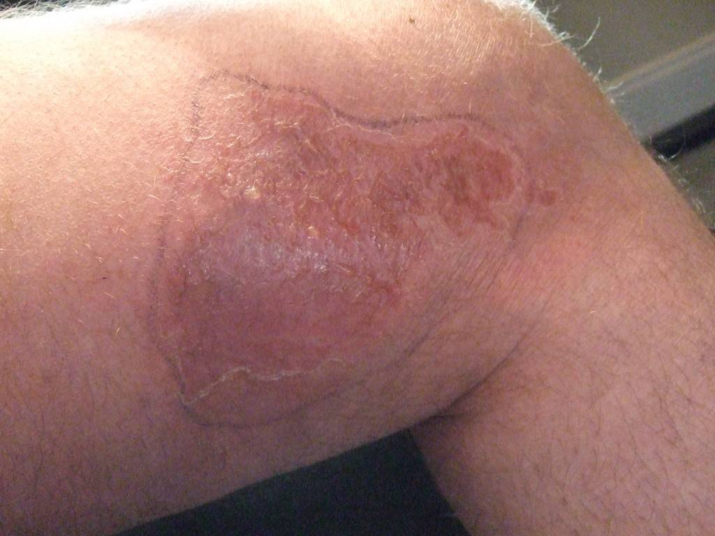 Knee 14 days Antibiotics, 1 Day after CDS wrap applied .JPG