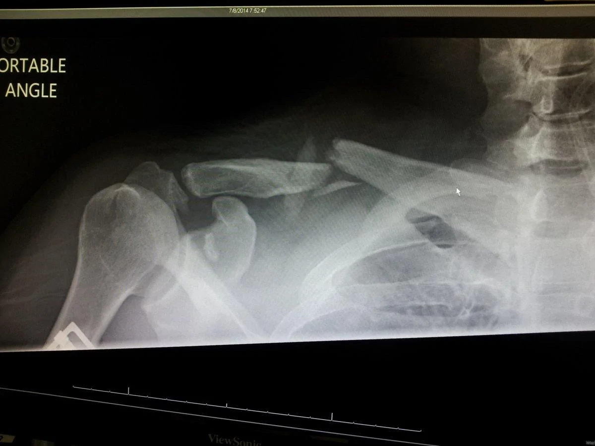 collarbone.webp