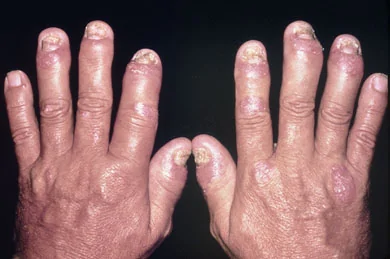 Sausage Fingers.jpg