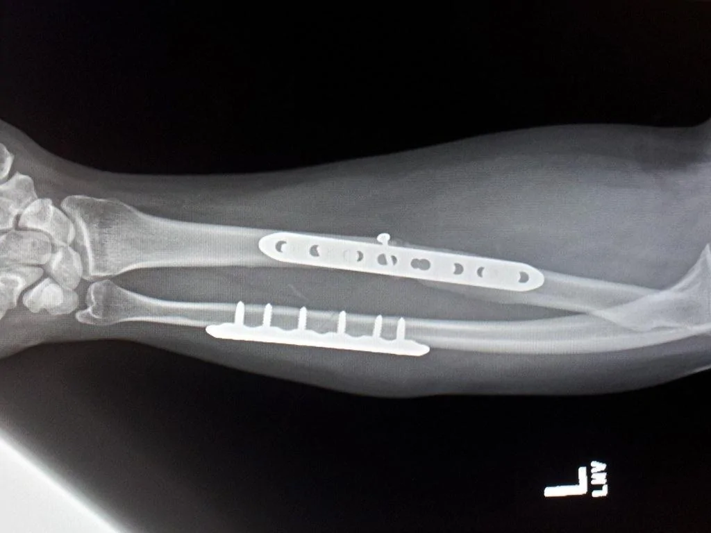 Broken_bones_a.webp